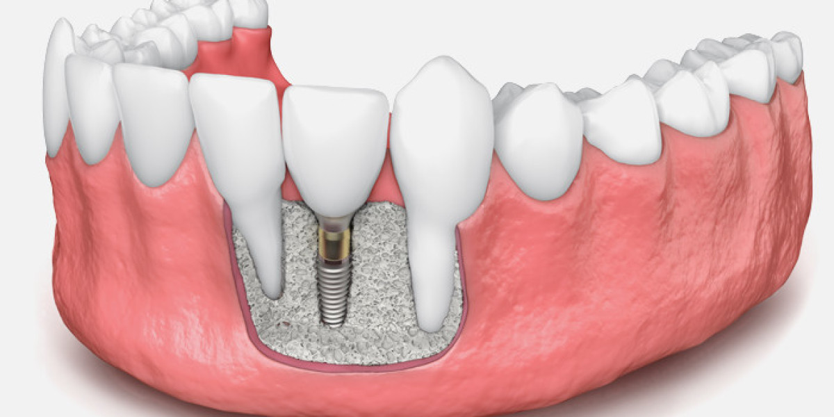 Alloplast Advancements in the Dental Bone Graft Substitute Market